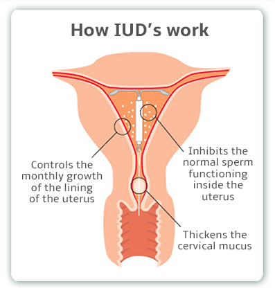 Iud Size Chart